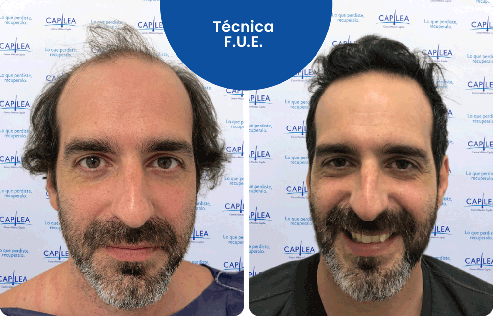 Técnica F.U.E.
