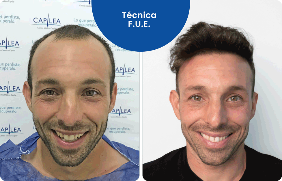 Técnica F.U.E.
