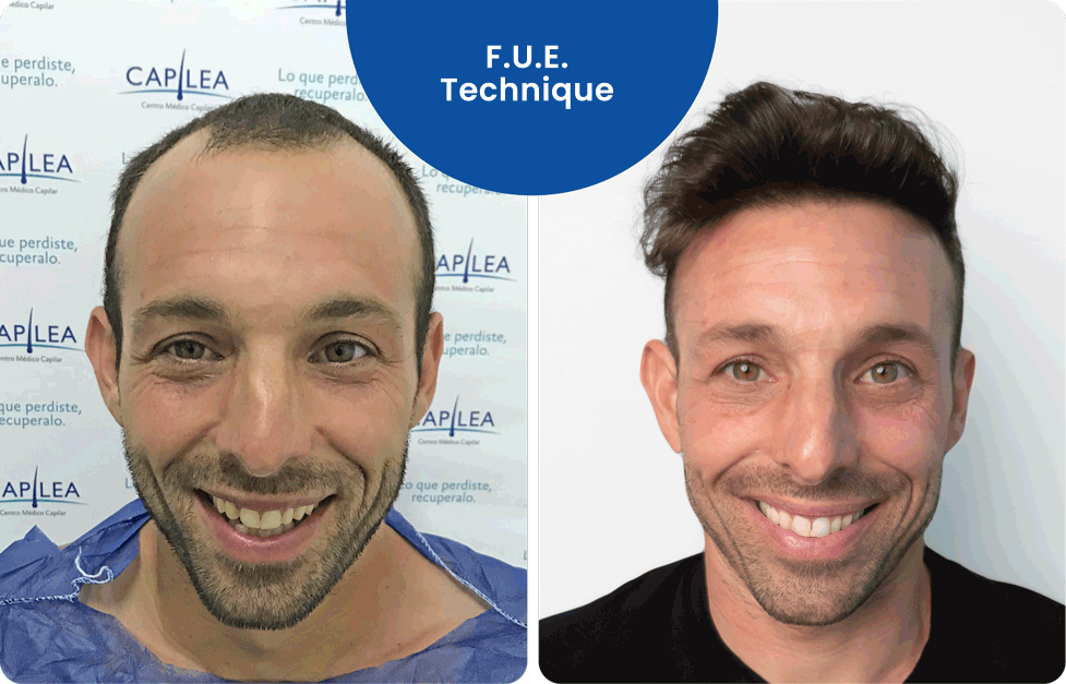 F.U.E. Technique