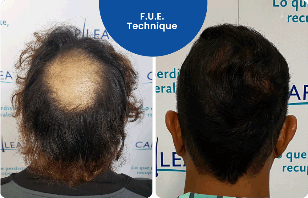 F.U.E. Technique